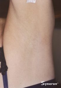 Underarm without hair after laser removal